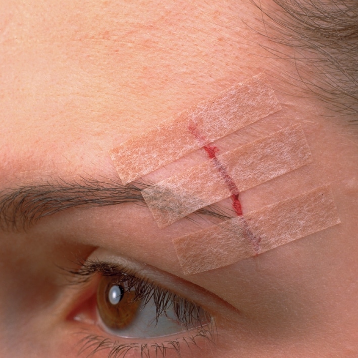 3M Steri-Strip Blendtone 12 x 100 mm,